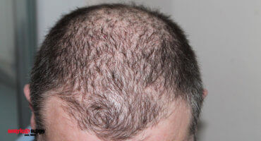 Haarausfall - Haarausfall Frauen und Männer Ursachen